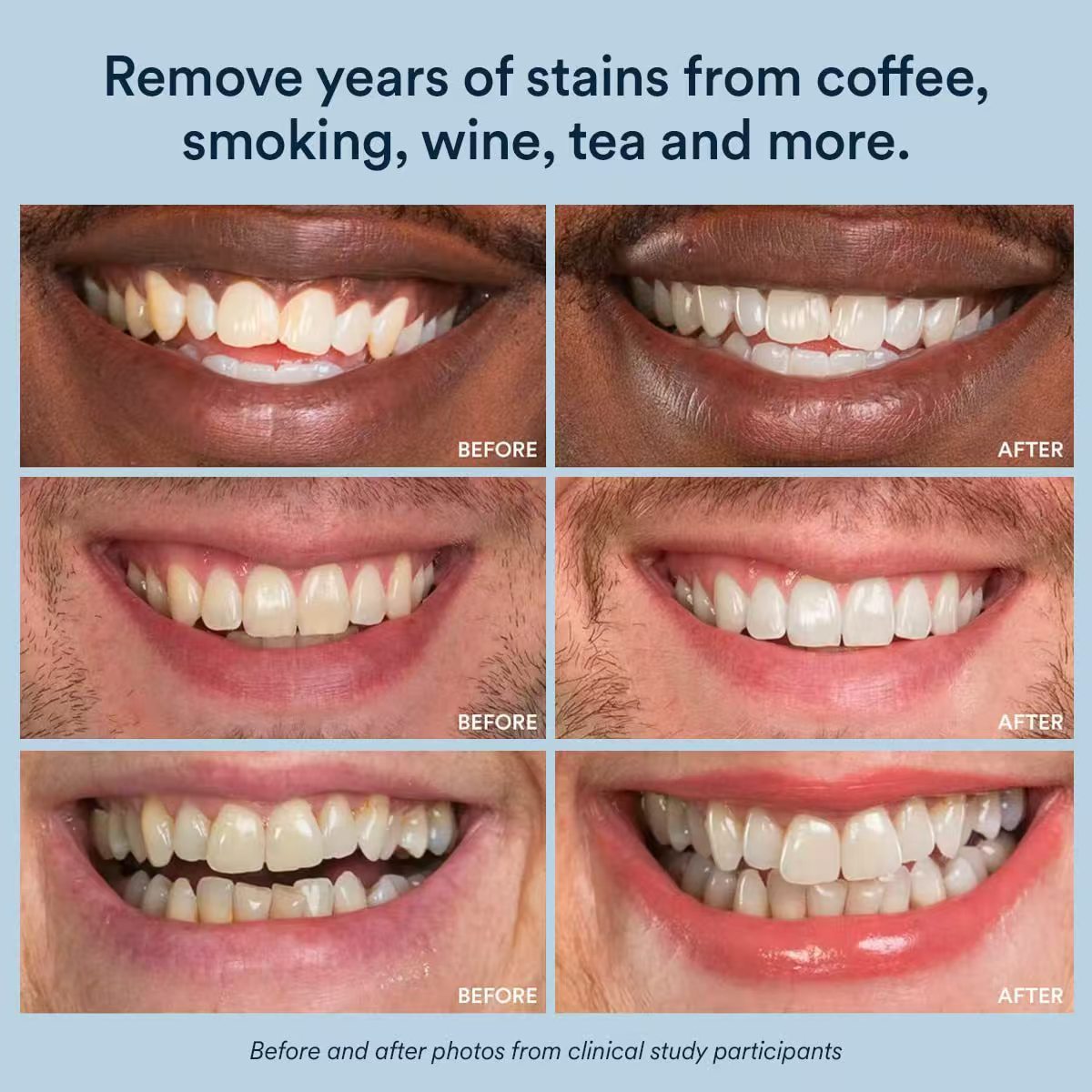 Purple Whitening Strips with Hydrogen Peroxide – Dentist-Grade Teeth Whitening