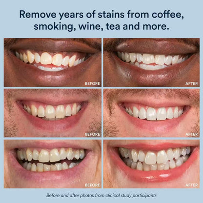 Purple Whitening Strips with Hydrogen Peroxide – Dentist-Grade Teeth Whitening